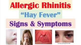 Symptoms and treatment for allergic rhinitis [upl. by Anitnuahs]