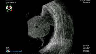 Tumor B scan Sonomed Escalon Ophthalmic Ultrasound [upl. by Andeee]