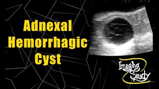 Adnexal Hemorrhagic Cyst  Ultrasound  Case 61 [upl. by Morvin191]