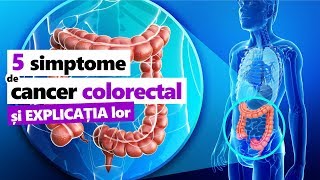 5 SIMPTOME EXPLICATE Cancer de Colon  Colorectal [upl. by Eentruoc]