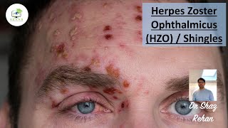 Herpes Zoster Ophthalmicus HZO Aka Shingles How does it Effect the Eye Can it Be Treated [upl. by Fleming307]