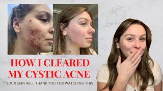 BLUE Light Therapy for CYSTIC ACNE  Skincare Routine [upl. by Ahsinaj]