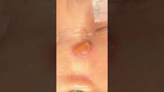 Basal cell carcinoma Local flap surgery skincancer carcinoma dermatology skincancersurgery [upl. by Neyugn]