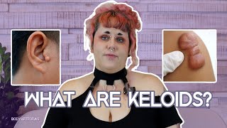 What are keloids [upl. by Llenrrad]