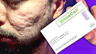 Usé el gel KITOSCELL por 6 meses En Mis Marcas de Acne [upl. by Eah24]