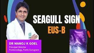 SEAGULL SIGNbronchoscopy ebus lungcancer pulmonologist endoscopicprocedure endoscopy [upl. by Ierna]