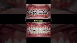 Braces Fix Misaligned Jaw braces orthodontist dentist bracesoff [upl. by Mireille913]