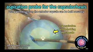 CataractCoach™ 2384 aspiration probe for the capsulorhexis [upl. by Jan]