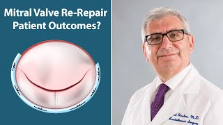 Mitral Valve ReRepair Outcomes with Dr Sabet Hashim [upl. by Schmeltzer531]