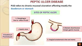 Peptic ulcer disease  DrVShanthi [upl. by Oniger]