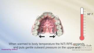 NiTi Palatal Expander  Orthodontics [upl. by Nasaj]