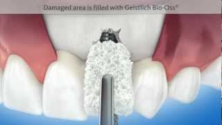 Dental animation Bone formation around a dental implant GEISTLICH  3D Animation Medizin [upl. by Eceinehs730]