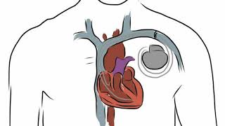 Difference Between Cardioversion and Defibrillation [upl. by Nolyat]