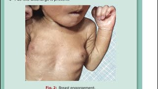 “Unpacking Breast Engorgement Causes Symptoms amp Relief Tips for Newborns newborn [upl. by Eca]