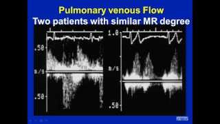 Mitral Regurgitation Revisited  Pitfalls in Severity Assessment [upl. by Barnum107]