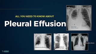 Pleural Effusion  Types Causes Evaluation amp Management All You Need To Know For Exam [upl. by Zimmer]