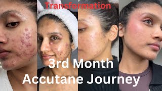 3Month Accutane Update My Skin Progress So Far [upl. by Honey438]