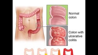 Ulcerative Colitis [upl. by Asilec]