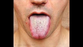 ORAL CANDIDIASIS Oral Thrush Causes Symptoms How To Treat White Tongue [upl. by Maise737]