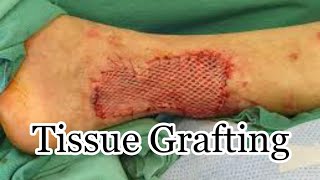 Tissue Grafting  MisMedicine [upl. by Aicirtel344]