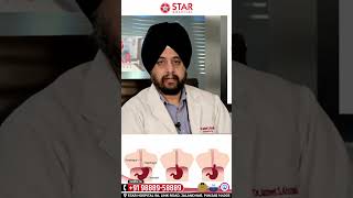 Is Hiatus Hernia Operation being Important Kya Hiatus Hernia Ka Operation krana jruri Hai [upl. by Brennen]