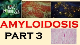 AMYLOIDOSIS PART 3 Morphology Diagnosis Special stains clinical features amp Prognosis [upl. by Sela767]