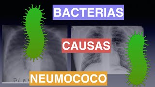 ¿Cuáles son las causas de la Neumonía [upl. by Marsiella]