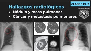 052  Nódulo y masa pulmonar cáncer y metástasis pulmonares Tórax Pt 2 [upl. by Letnohc]