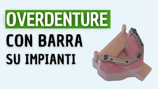 BARRA su Impianti dentali per OVERDENTURE [upl. by Iclehc23]