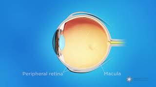 What is retinopathy of prematurity ROP [upl. by Ehttam]