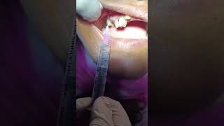 Local Infiltration anesthesia LIA  Upper Premolar  DrteethSohel semapur [upl. by Marillin]