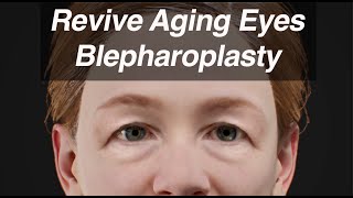 Blepharoplasty Eyelid Surgery to Revive Aging Eyes and Look Years Younger [upl. by Lonnie9]