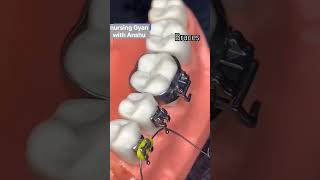 braces orthodontics braces orthodontist dental dentist shorts viralshorts [upl. by Fine]