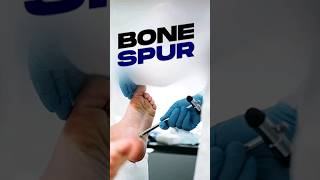 How Arthritis Leads to Cartilage Wear Bone Spurs and Joint Calcification [upl. by Sitnik]