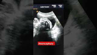 Anencephaly [upl. by Schaffel]