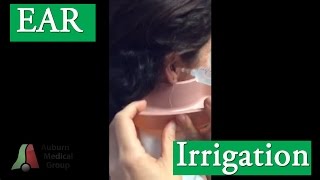 Ear Irrigation for Cerumen Ear Wax Removal  Auburn Medical Group [upl. by Nnyw522]