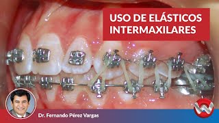 Uso de Elásticos Intermaxilares [upl. by Filahk347]