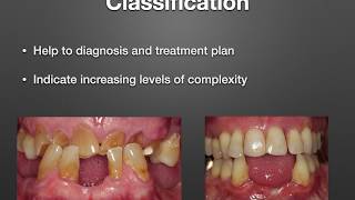 Diagnosis amp Treatment Planning A Prosthodontic Perspective [upl. by Leba]