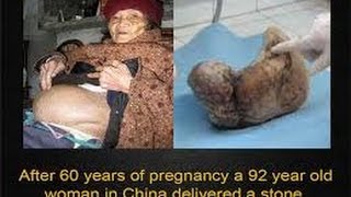 SYMPTOMS OF LITHOPEDION  STONE BABY II लिथोपैडिओन के लक्षण  पत्थर का बच्चा II [upl. by Homans]