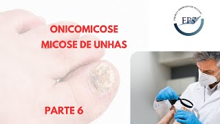 Onicomicose  Micose de Unhas  Parte 6  Cuidados com os Calçados [upl. by Ahcropal431]