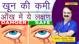 ख़ून की कमी आँख में ये लक्षण  IRON DEFICIENCY DONT OVER LOOK YOUR LOWER EYELID [upl. by Ycrad]