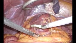 Laparoscopic Caudate Lobectomy [upl. by Lat]