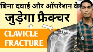 Clavicle 🦴 bone fracture treatment in hindi clavicle fracture recovery time collar bone broken [upl. by Robenia195]