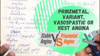 Prinzmetal Variant Vasospastic or Rest Angina  Stable VS Prinzmetal Angina [upl. by Laerol]