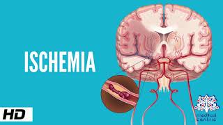 Ischemia Causes Signs and Symptoms Diagnosis and Treatment [upl. by Lajes]