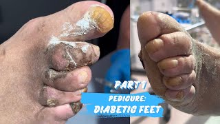 PEDICURE FOR DIABETIC FEET PART 1 [upl. by Sulienroc]