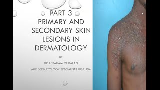 PRIMARY AND SECONDARY SKIN LESIONS CONFIGURATION AND DISTRIBUTION OF SKIN DISEASESeducation duet [upl. by Teplica68]