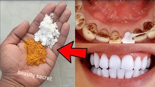 easy teeth whitening at home [upl. by Cheyne]