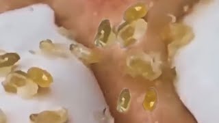 Extraction profonde des points noirs Acné kystique et popping 6 [upl. by Otrevlig]