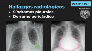 051  Derrame pleural neumotórax empiema y derrame pericárdico Tórax Pt2 [upl. by Thirzia]